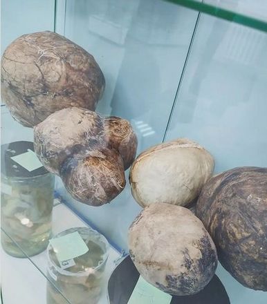 Гигантские опухоли покажут нижегородцам в музее ПИМУ - фото 1
